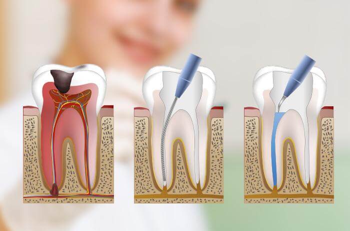 endodoncia-dental